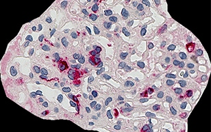 CD68（巨噬细胞）的肾小球占比自动分析