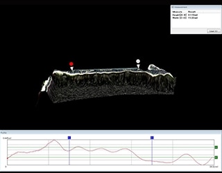 生物可降解性扩张导管支架的3D形状、轮廓测量